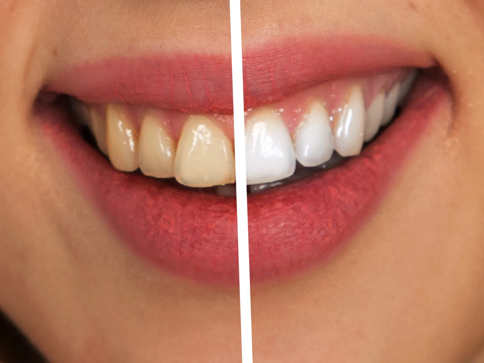 peroxide-teeth-whitening-before-after-results